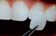Lente de contato dental uberaba 3077-3228