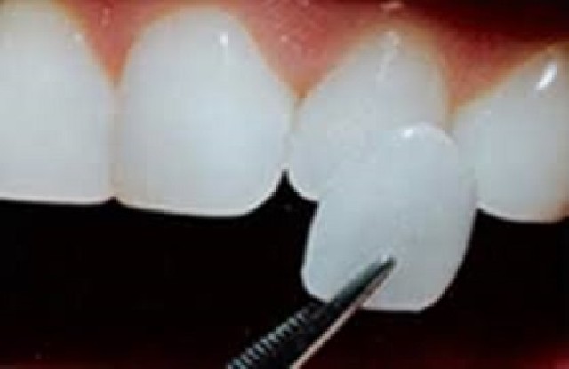 Foto 1 - Lente de contato dental uberaba 3077-3228