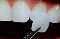 Lente de contato dental uberaba 3077-3228